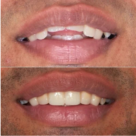 before and after dental smile makeover comparison, professional photography