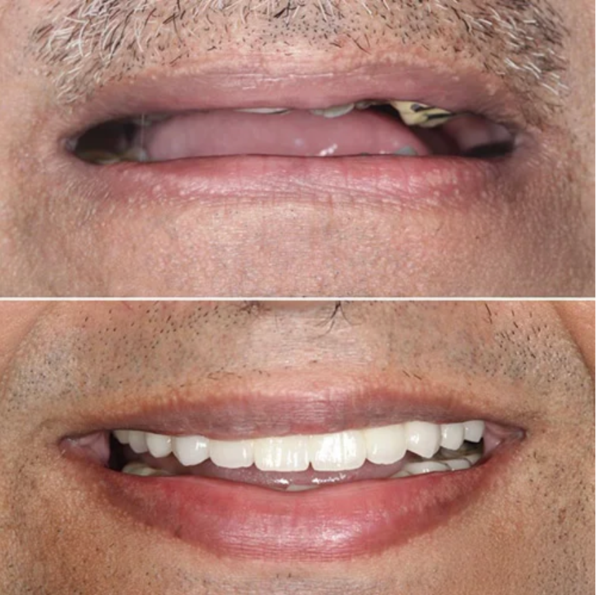 before and after dental crowns treatment comparison, professional photography
