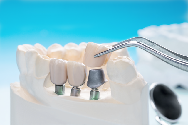 Cosmetic Smile Makeover