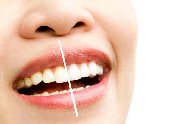 Cosmetic Smile Makeover